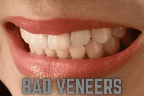 bad veneers