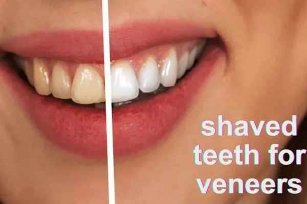 shaved teeth for veneers