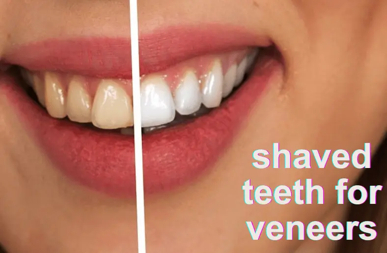 shaved teeth for veneers